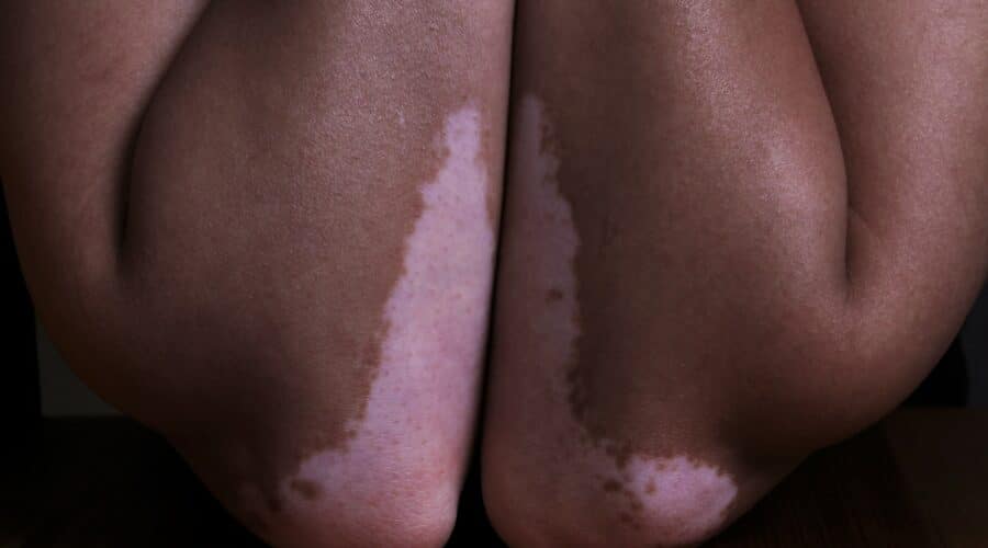 Vitiligo - Symptome, Ursachen und Behandlung