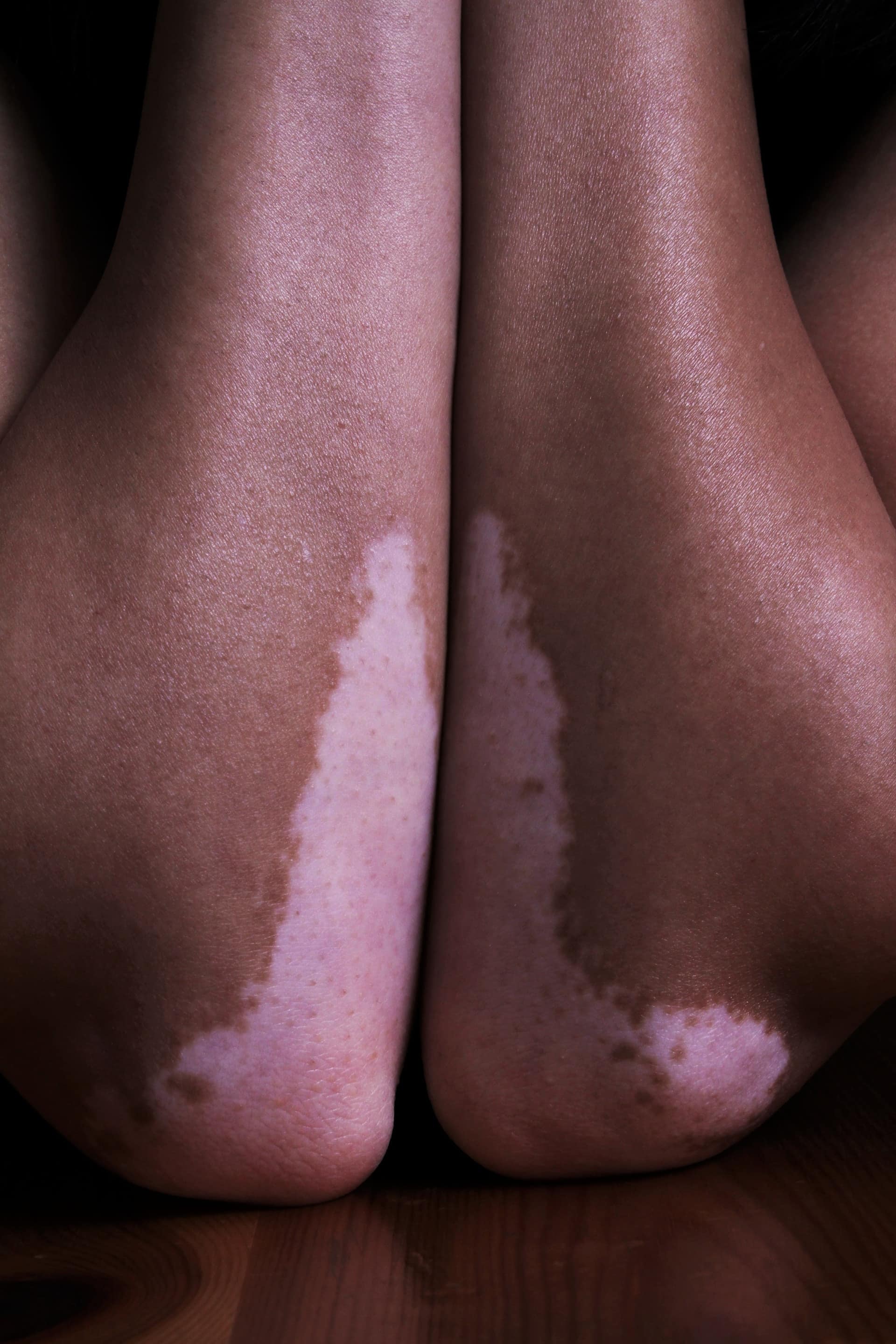 Die wichtigsten Symptome von Vitiligo sind weiße Flecken auf der Haut