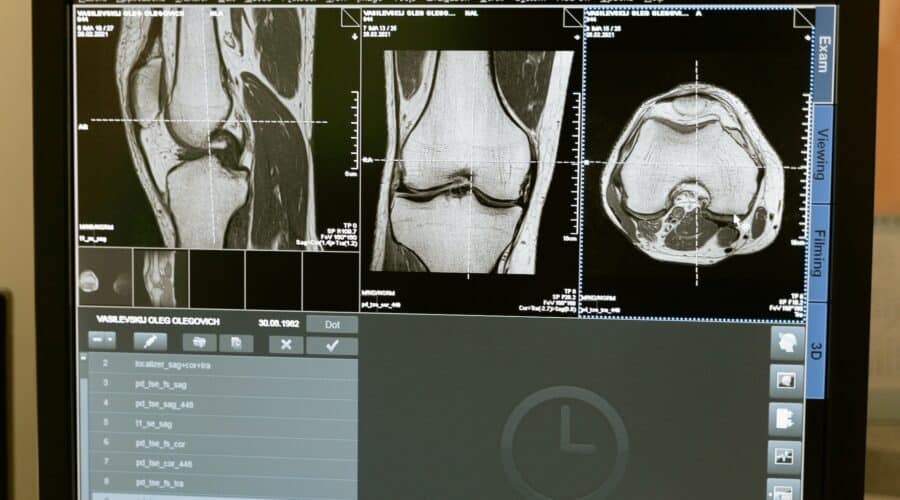 Vorteile von Chondroitin bei Arthrose und Gelenkschmerzen