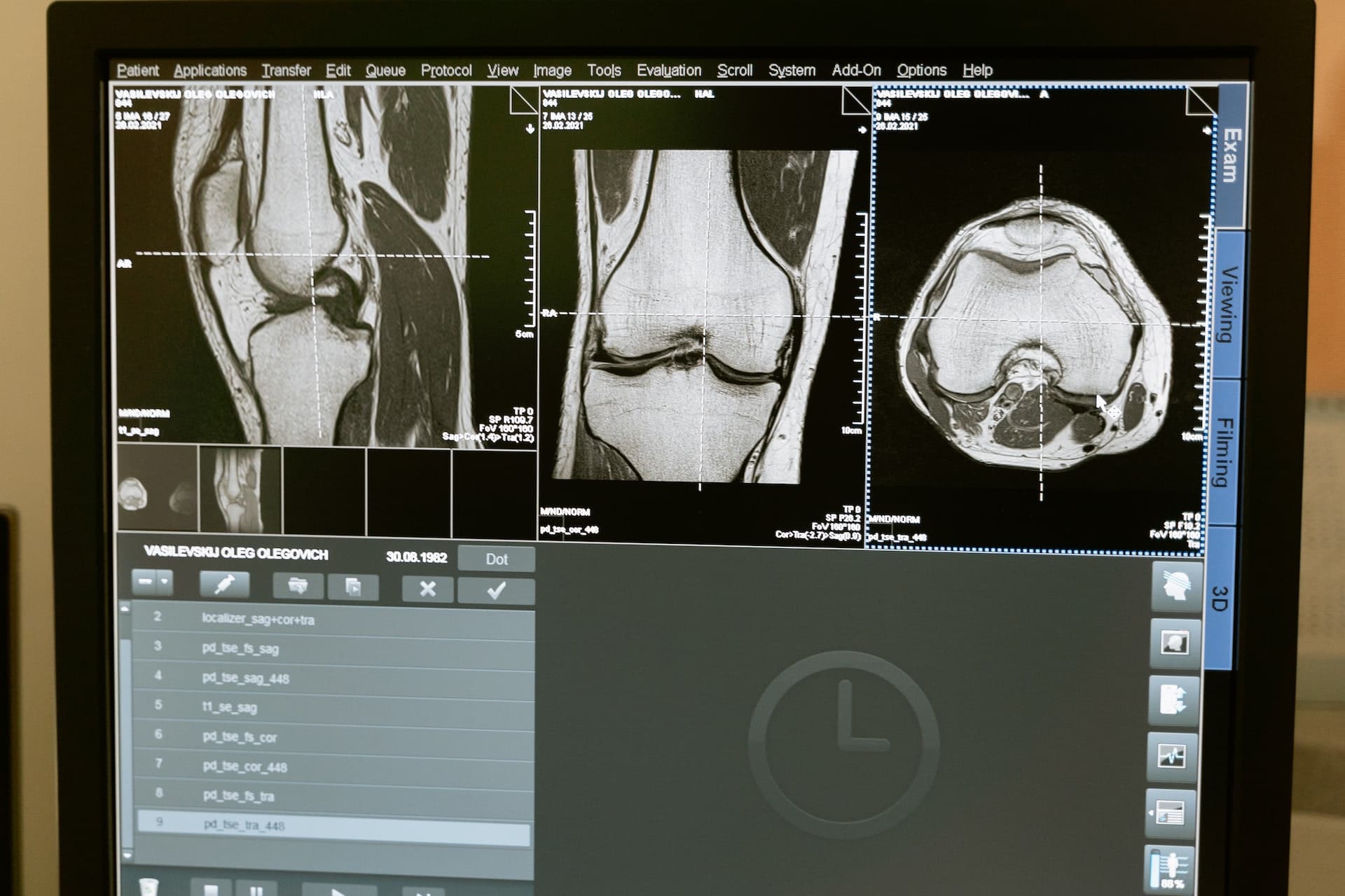 Vorteile von Chondroitin bei Arthrose und Gelenkschmerzen