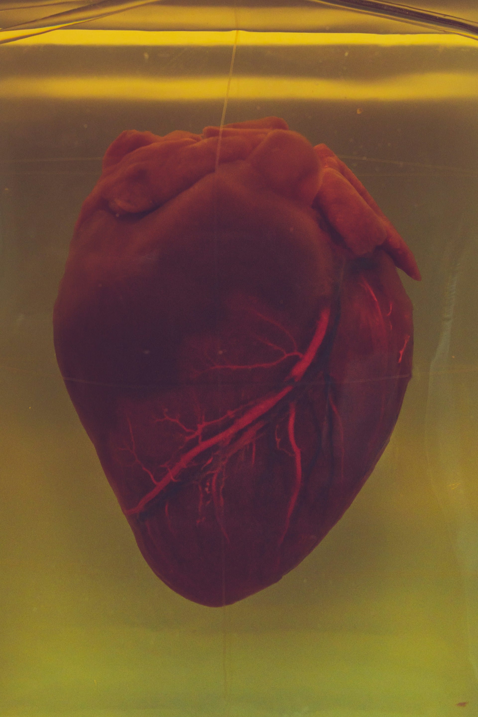 Metastasierter Herzkrebs: Die häufigere Realität
