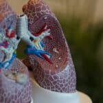 Verbesserte Atmung durch Entfernen von Lungenteilen