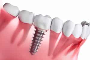 Von Vorsorge bis Implantat: Worauf es beim Zahnarzt in Düsseldorf ankommt