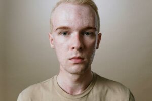 Aknenarben – Ursachen, Formen und Behandlung