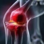 Knieoperation – Ablauf, Methoden und Nachbehandlung